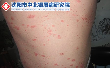 沈阳治疗牛皮癣医院