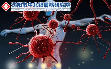 沈阳银屑病专科医院,沈阳哪些银屑病医院比较好