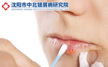 沈阳哪家看牛皮癣,沈阳看牛皮癣医院,沈阳牛皮癣医院收费