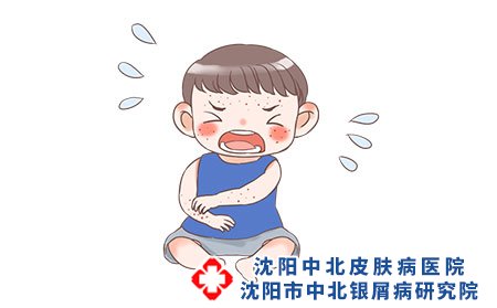 孩子脖子出现银屑病怎么回事