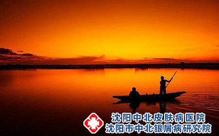 沈阳中北医院哪个医生治疗牛皮癣好?