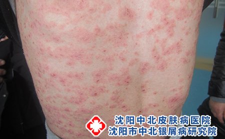 预防银屑病的方法有哪些_沈阳中北银屑病医院